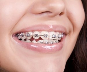 أسعار تقويم الأسنان